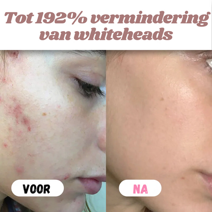 White & Black Rice Peel Shots – Verjongende Huidtransformatie